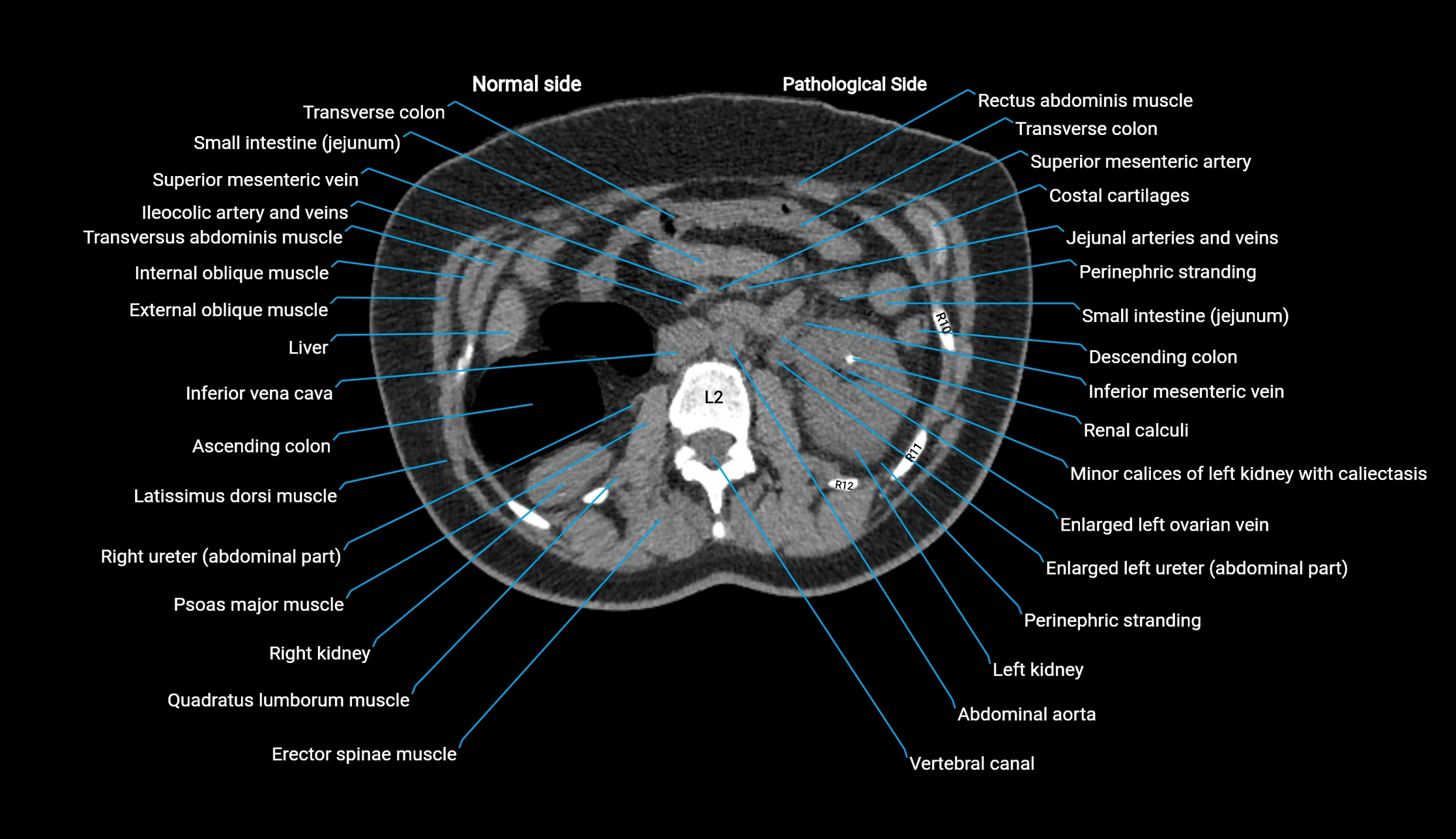 CT KUB axial cross sectional anatomy  radiology image -img-00201-00053.webp